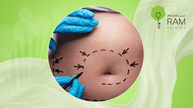 شفط-الدهون-بالفيزر