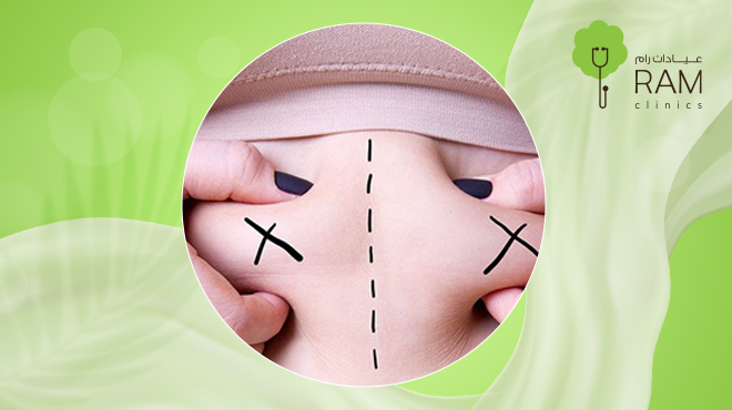 شفط-الدهون-بالفيزر