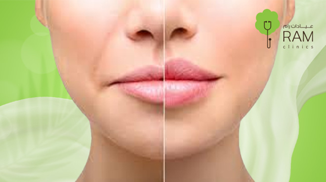 انواع-فيلر-الشفايف انواع-فيلر-الشفايف