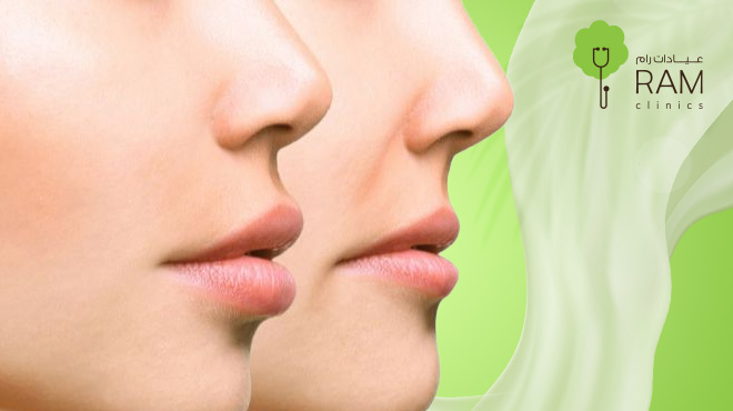 فيلر-الراديس