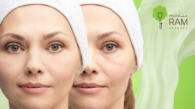 فيلر-تحت-العين فيلر-تحت-العين