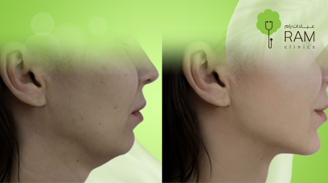 فيلر-الذقن فيلر-الذقن