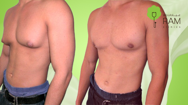 سعر-عملية-ازالة-التثدي-عند-الرجال