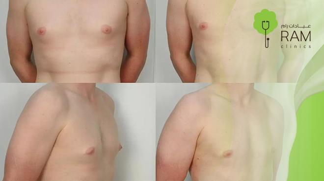 شكل-التثدي-عند-الرجال