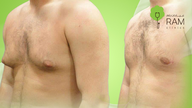 كيفية-ازالة-التثدي-عند-الرجال