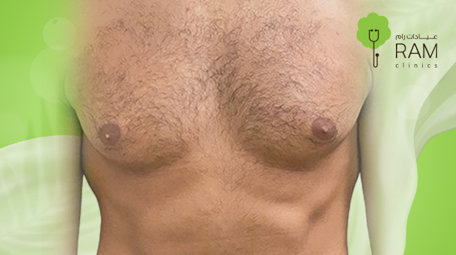 ما-بعد-عملية-التثدي-للرجال