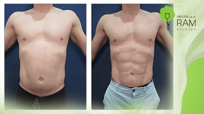 شفط-الدهون-بالليزر-قبل-وبعد