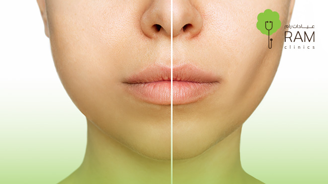 عملية-غمازات-الوجه