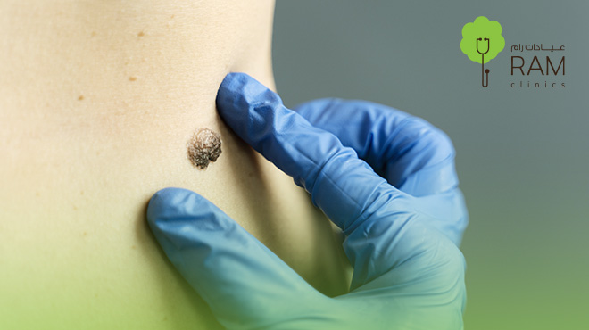 ازالة-الزوائد-الجلدية