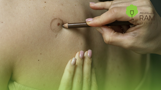 هل-ازالة-الزوائد-الجلدية-خطيرة