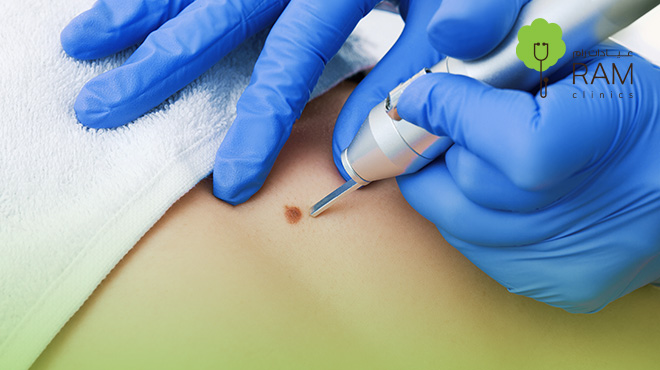  ازالة-الزوائد-الجلدية-بالليزر