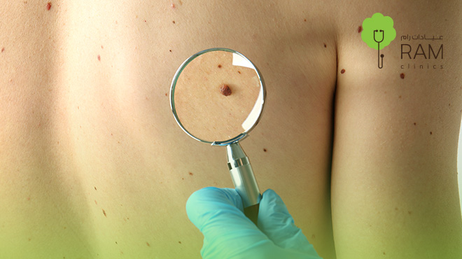 مركز-ازالة-الزوائد-الجلدية