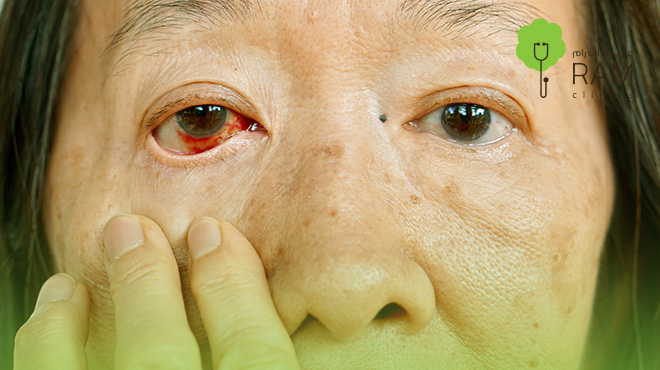 مخاطر-عملية-شد-الجفون