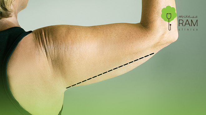 عملية-شد-الذراعين