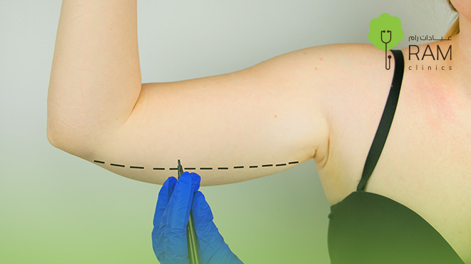 عملية-شد-الذراعين