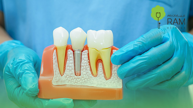 أسعار-زراعة-الأسنان-في-البحرين