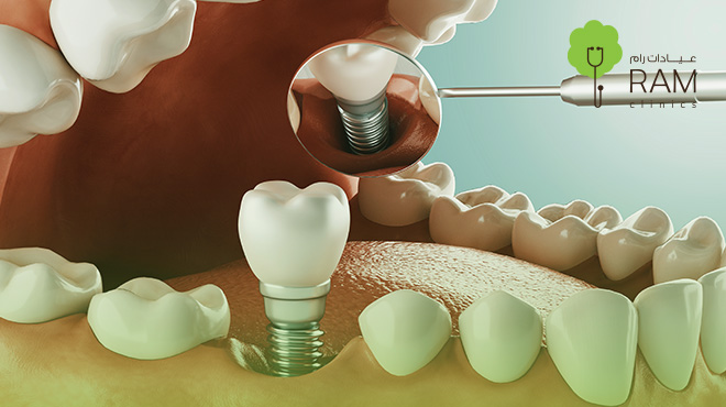أنواع-زراعة-الأسنان-واسعارها