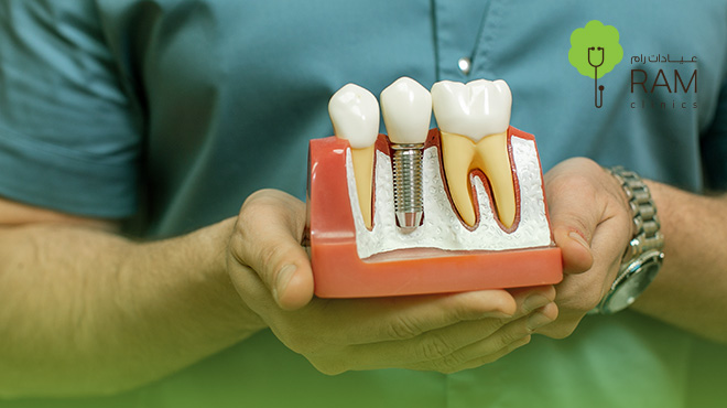 أنواع-زراعة-الأسنان-واسعارها