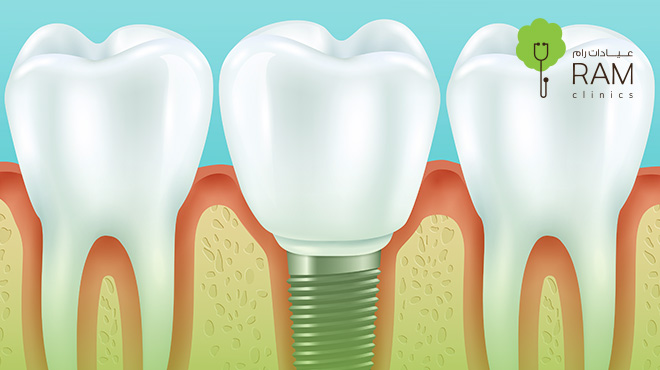 أنواع-زراعة-الأسنان-واسعارها