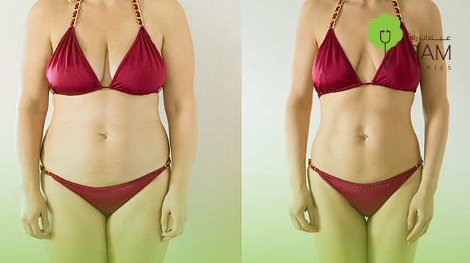 مميزات-وعيوب-نحت-الجسم