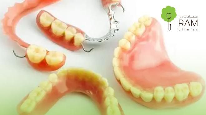 تلبيسة-أسنان-مؤقتة