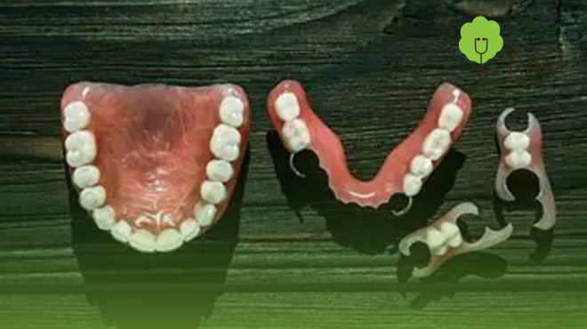 تلبيسة-أسنان-مؤقتة