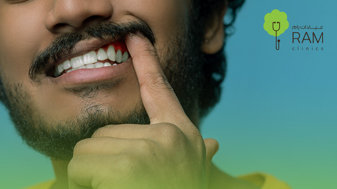 اسباب-سرطان-اللثة