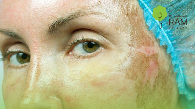 التقشير-الكيميائي