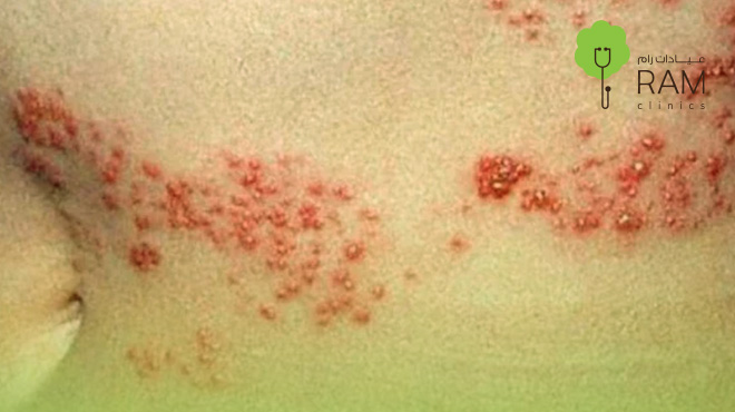 علاج-الحزام-الناري علاج-الحزام-الناري