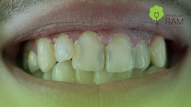 تآكل-الأسنان-الأمامية 