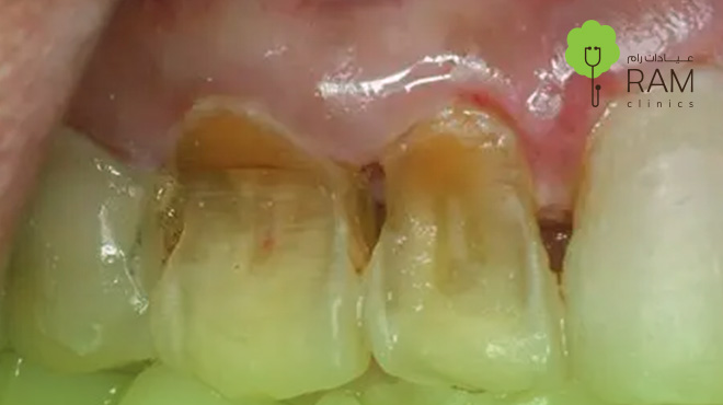 تآكل-الأسنان-الأمامية 
