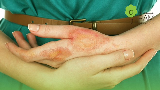 نسبة-نجاح-عملية-ترقيع-الجلد