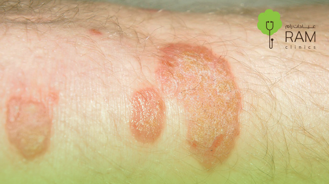 ما-بعد-عملية-ترقيع-الجلد