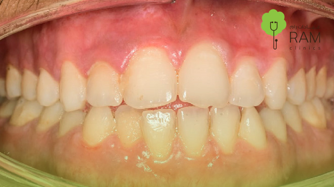 توريد-اللثة-للمدخنين