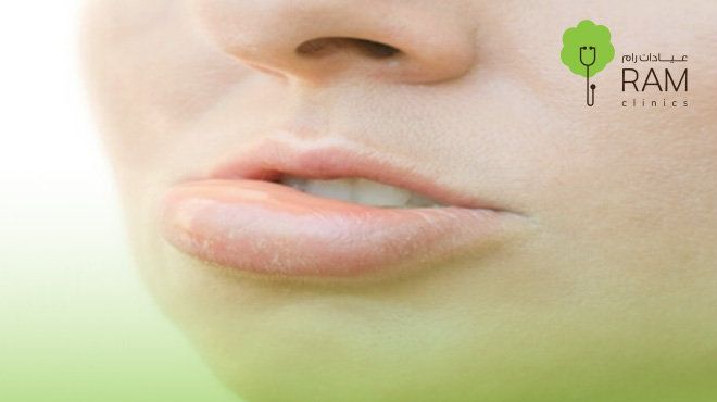 الشفايف-بعد-الفيلر 