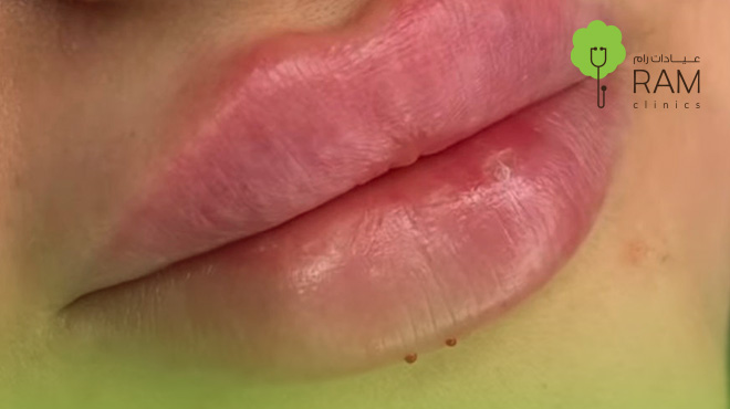 الشفايف-بعد-الفيلر 