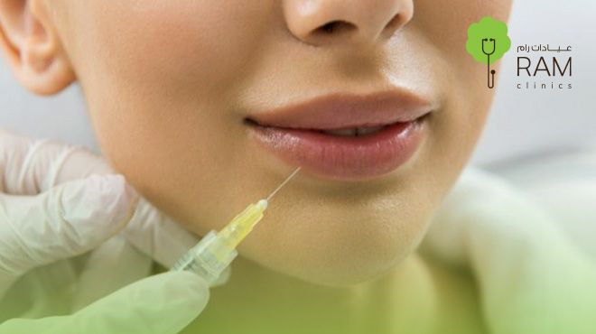 الشفايف-بعد-الفيلر 