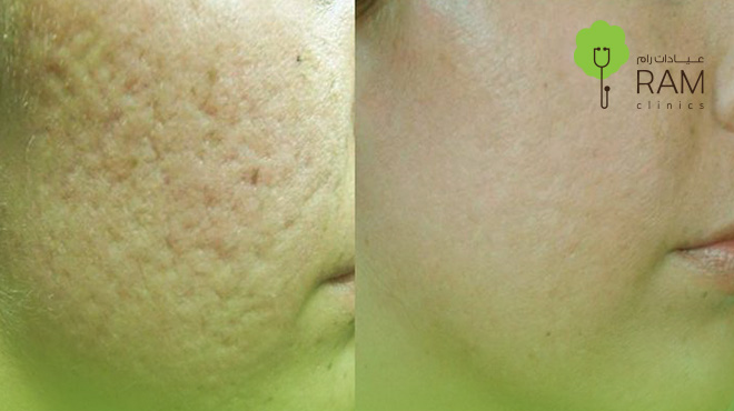 جلسة-تقطيع-الألياف