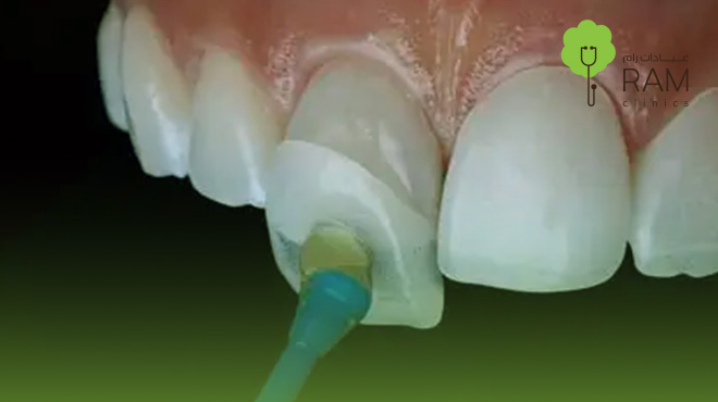 عدسات-الفينير-للاسنان