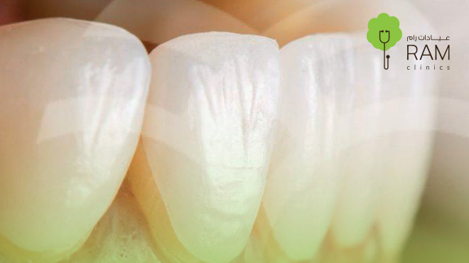 عدسات-الفينير-للاسنان