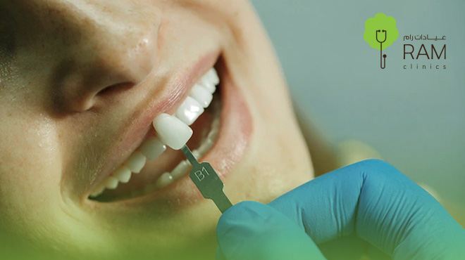 عدسات-الفينير-للاسنان