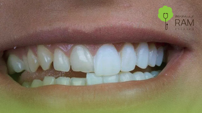 عدسات-الفينير-للاسنان