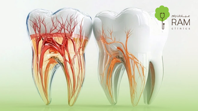 علاج-عصب-الأسنان