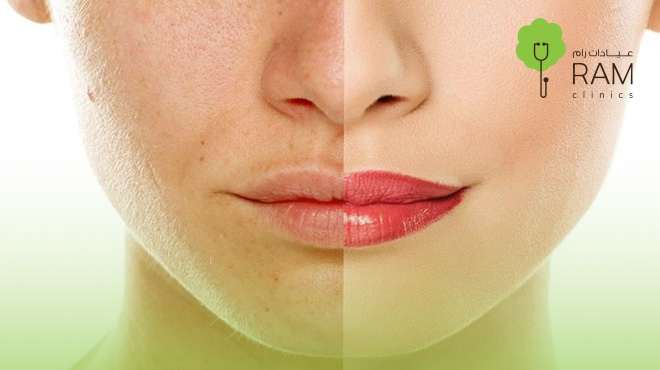 علاج-الكلف-بالليزر-بالصور