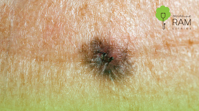 سرطان-الجلد