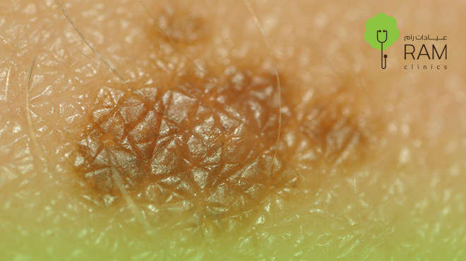 شكل-سرطان-الجلد-في-بدايته