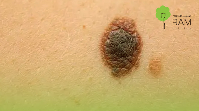 علامات-سرطان-الجلد