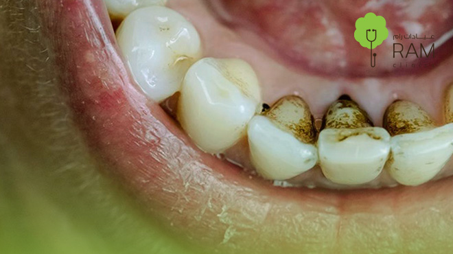 جير-الأسنان-الأسود