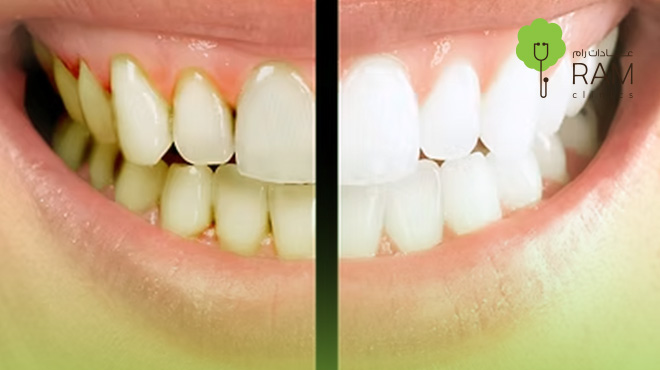 علاج-جير-الأسنان-الأسود