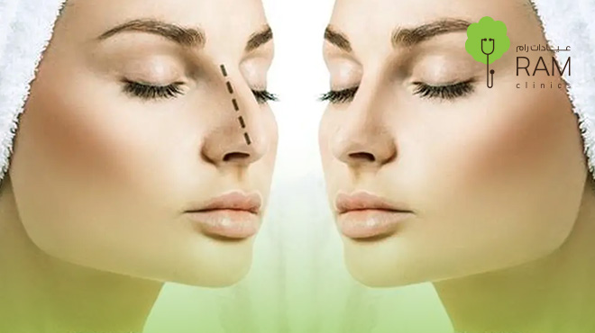 نتائج-عملية-تجميل-الانف-اللحمي